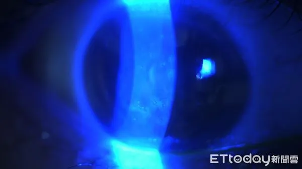 微孢子蟲感染。（圖／醫師提供）