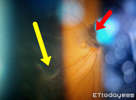 ▲視神經盤附近的結痂(紅色箭頭)，會造成視野缺損。此外      部分視網膜血管也出現滲漏、產生玻璃體發炎與出血，大片       的飛蚊症會干擾患者視軸(黃色箭頭)，甚至造成視力下降。。（圖／洪啟庭醫師提供）