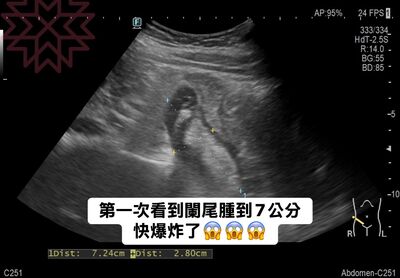 她胃超痛　醫驚：第一次看到闌尾腫成7公分！快爆炸