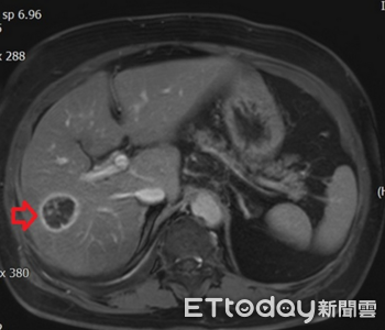 8旬婦「多重慢性病」罹肝癌難開刀 醫用射頻燒灼術3天出院
