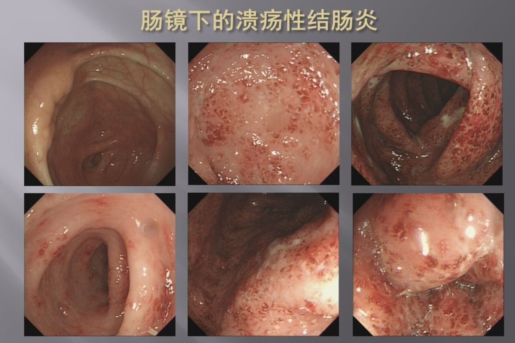 ▲寧波一名22歲年輕男子因長期吃泡麵配零食當正餐，患上需終身服藥控制的重度潰瘍性結腸炎。（圖／翻攝錢江新聞）