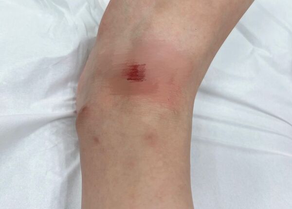 ▲高雄女遭犬隻咬傷，當場血流如注，到醫院縫2針。（圖／翻攝自爆料公社）