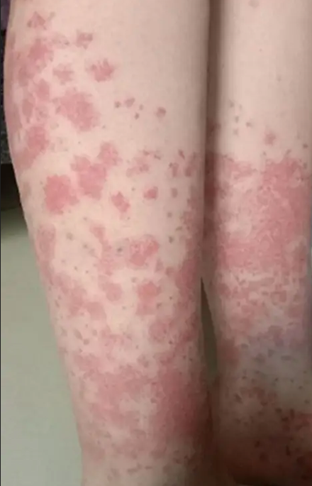 ▲大陸一名女子每月都染髮，竟因此全身冒出紫斑。（圖／翻攝自微博）