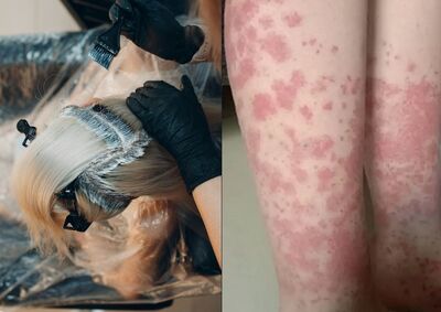 20歲正妹每月染髮！「全身爆紫斑」尿變咖啡色　醫剃光頭救命