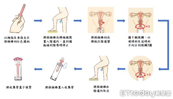 ▲▼   子宮頸癌      。（圖／李佳純助理教授提供）