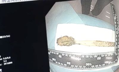 牙刷卡腸子52年！老翁不忍全說了：當年「才12歲」怕被罵