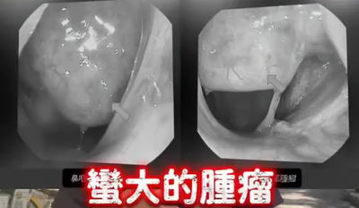 30歲男「長期鼻塞」竟是癌症 醫:腫瘤幾乎填滿空間