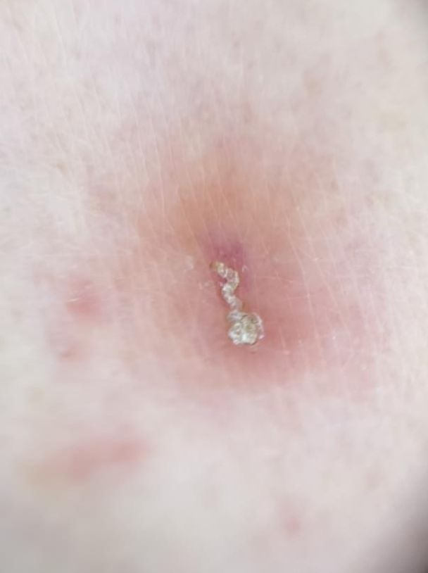▲▼疥瘡患者皮膚病灶會出現蟲隧道(Burrow)。（圖／北榮提供）