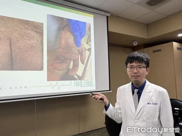 ▲▼北榮皮膚部記者會，說明「夜間搔癢難耐，竟是疥瘡找上門」。（圖／記者洪巧藍攝）