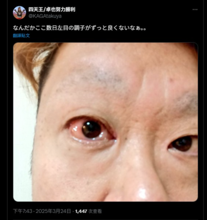 ▲▼38歲日諧星卓也努力勝利腦幹梗塞逝世！　生前曾PO左眼出血照。（圖／翻攝自X）