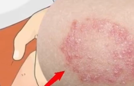 ▲股癬。（示意圖／翻攝自微博）