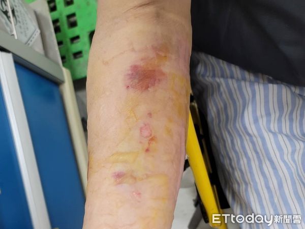 傷口抹蒜泥　傷口潰爛險引起蜂窩性組織炎。（圖／雙和醫院提供）
