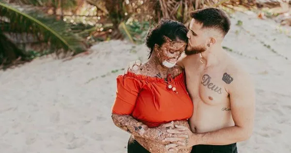 巴西一名女子罹患罕見疾病，導致皮膚一曬太陽就出問題。（圖／翻攝自kah05oficial IG）