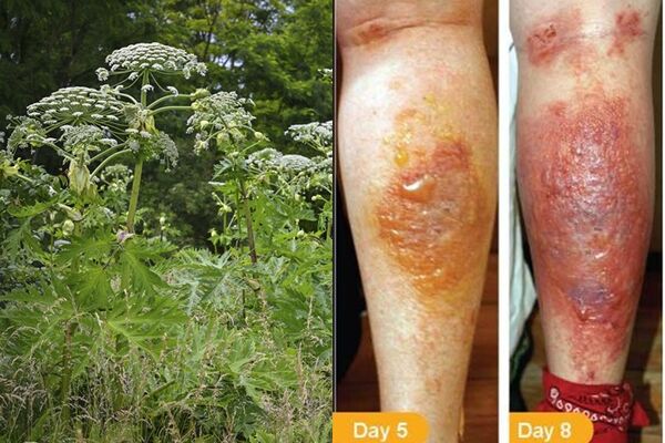 ▲▼日本北海道大學校內出現劇毒植物「巨型霍格威德」（giant hogweed）。（圖左／達志影像／美聯社、圖右／紐約州環境保護局）