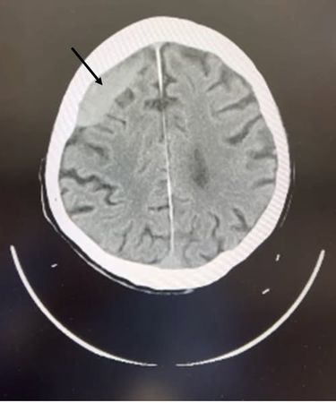 ▲▼黑色箭頭處顯示患者腦部有一處舊傷，才引發癲癇造成跌倒。（圖／員榮醫院提供）