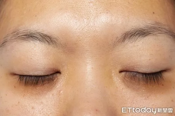 ▲▼     黑眼圈        。（圖／國泰醫院提供）