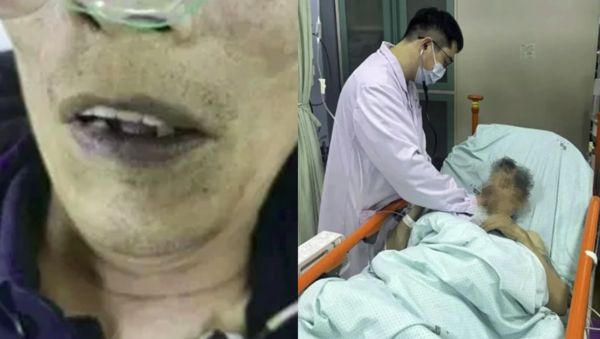 ▲▼陸翁吃自製榨菜「暈倒發紫」　送醫發現「亞硝酸鹽中毒」。（圖／翻攝微博）