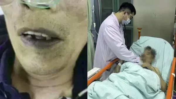 ▲▼陸翁吃自製榨菜「暈倒發紫」　送醫發現「亞硝酸鹽中毒」。（圖／翻攝微博）