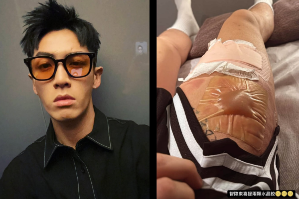 ▲柯震東大腿被燙傷。（圖／翻攝自IG）