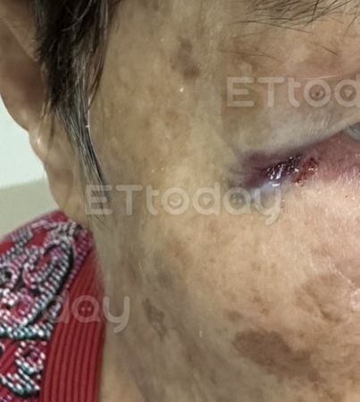 ▲阿嬤被打到手瘀青             。（圖／投訴人提供）