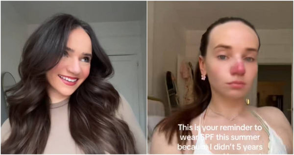 潔西卡5年前在西班牙特內里費島度假時曬傷，鼻子自此呈現永久性發紅，至今未癒。。（圖／翻攝TikTok／jess.mcgirr）