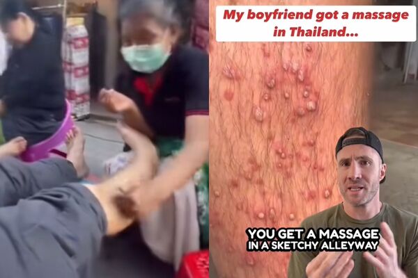 ▲▼泰國路邊按摩「腿爆膿瘡」畫面曝　醫警告：感染的完美組合。（圖／翻攝自TikTok）