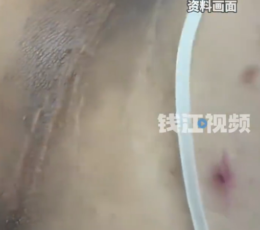 ▲小沖的家人起初以為只是洗澡沒洗乾淨。（示意圖／翻攝自微博）