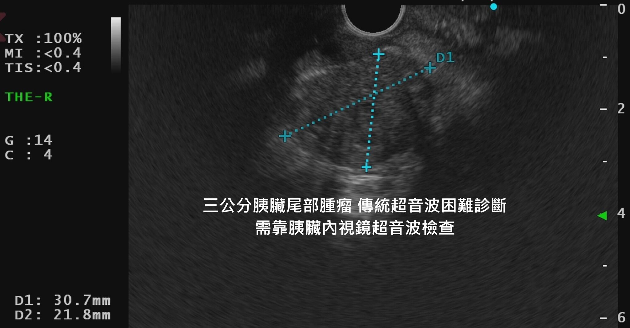 胰臟癌腫瘤 。（圖／翻攝林相宏臉書）