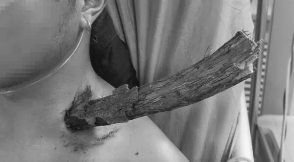 ▲▼樹枝掉落「插入頸部」12公分！　奇蹟「躲開所有大血管」。（圖／翻攝唐都醫院）