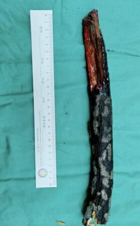 ▲▼樹枝掉落「插入頸部」12公分！　奇蹟「躲開所有大血管」。（圖／翻攝唐都醫院）