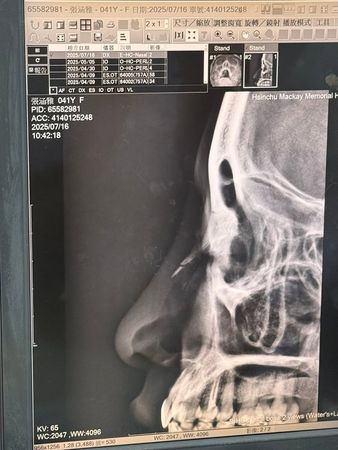 ▲《星光》張涵雅「鼻骨骨折」超慘傷照曝光！　被兒子頭撞：沒想到 。（圖／翻攝自張涵雅IG）