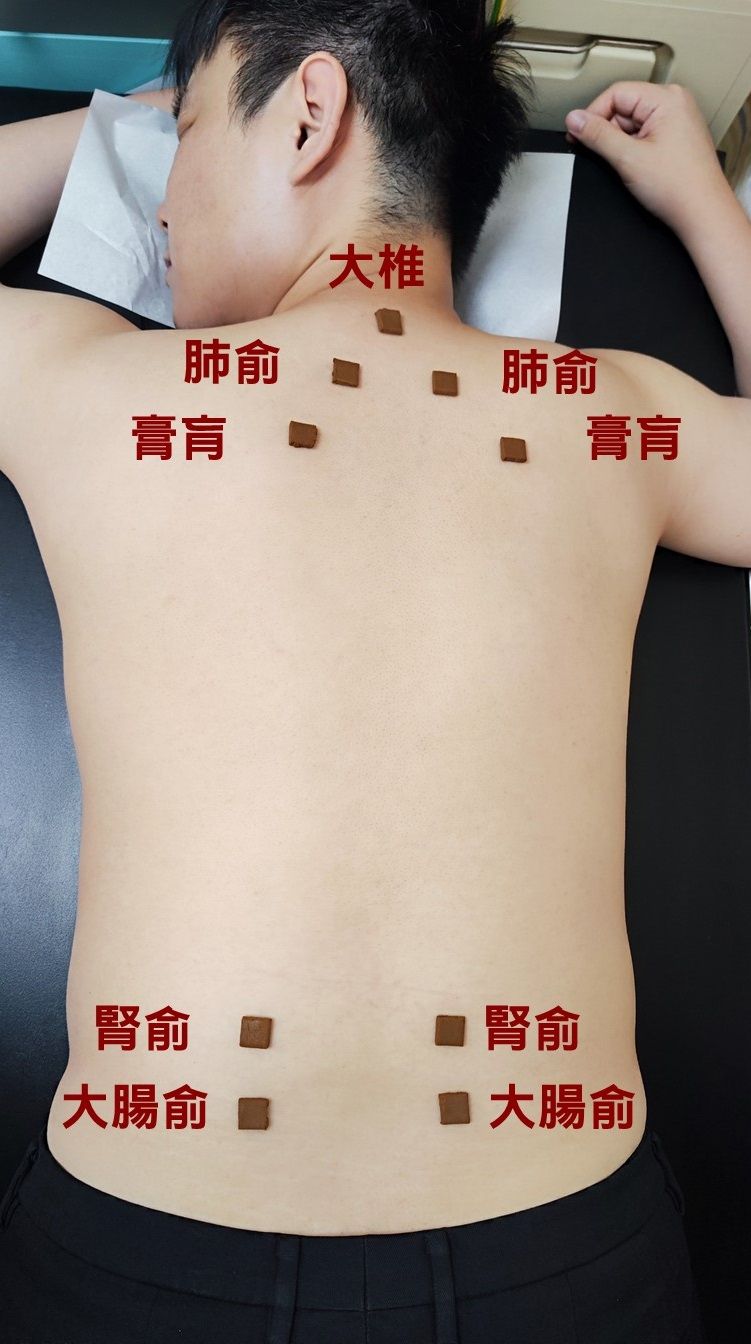 ▲▼三伏貼選擇背部大椎、肺俞、腎俞等穴位敷貼。（圖／馬偕醫院提供）