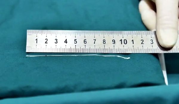 ▲▼陸男「生水刷牙」說不出話！大腦遭「裂頭絛蟲」入侵。（圖／翻攝微博）