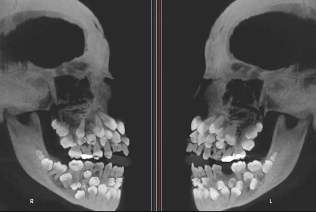 ▲▼巴西女童「竟長81顆牙」！恐怖X光照曝光。（圖／Courtesy of American Journal of Orthodontics and Facial Orthopedics）