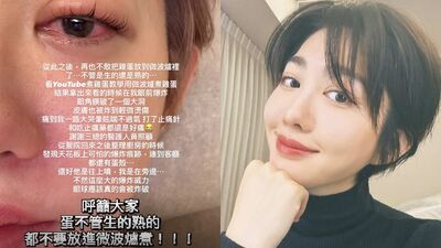王晴微波雞蛋炸傷眼！　「角膜破大洞」痛到狂哭：再也不敢了