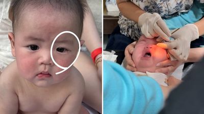 歐陽妮妮6月兒「起床一堆眼屎」！醫檢查驚見：裡面都發炎了  緊急動手術