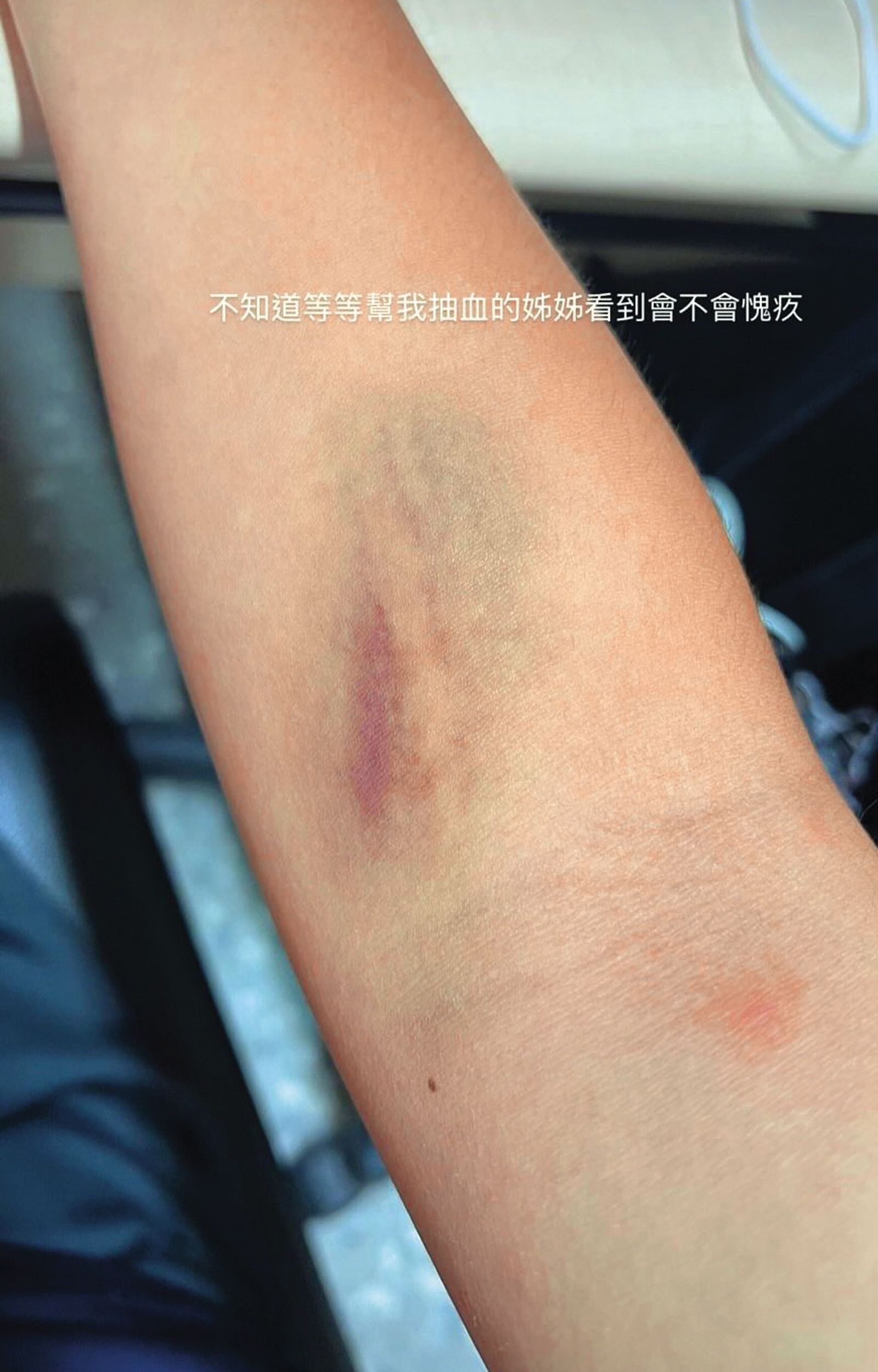 女足隊員簡奇陞被抽血處出現瘀青，看起來怵目驚心。（翻攝簡奇陞Threads）
