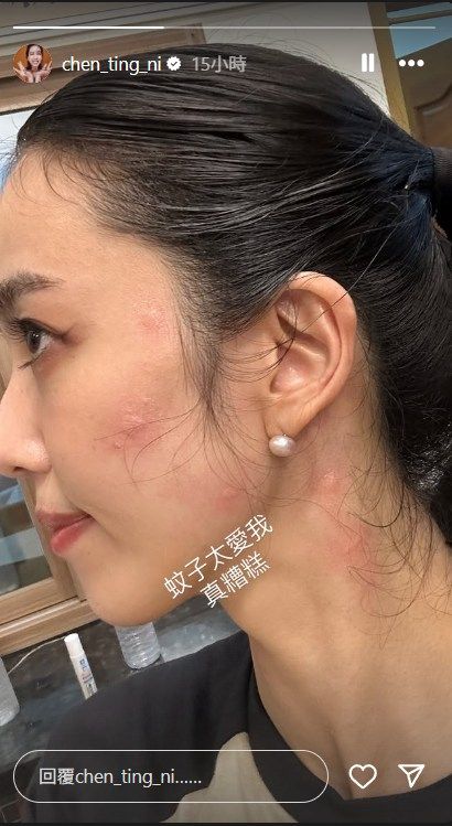 ▲▼陳庭妮臉蛋驚見「一排紅色大腫包」。（圖／翻攝自IG）