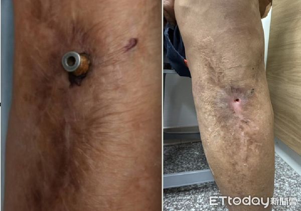 ▲莊老先生左小腿有螺絲外露，經手術順利取出。（記者林東良翻攝，下同）