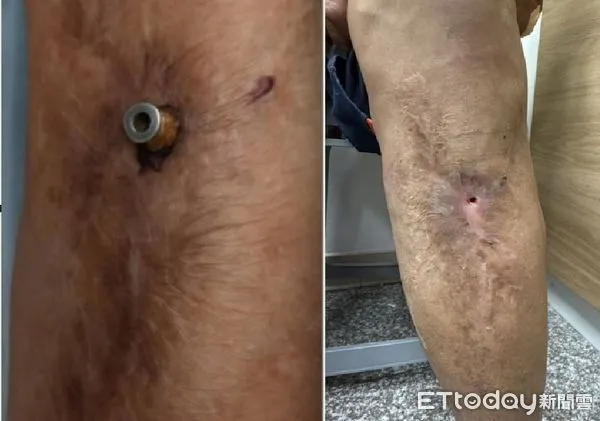 ▲莊老先生左小腿有螺絲外露，經手術順利取出。（記者林東良翻攝，下同）