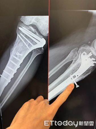 ▲莊老先生左小腿有螺絲外露，經手術順利取出。（記者林東良翻攝，下同）