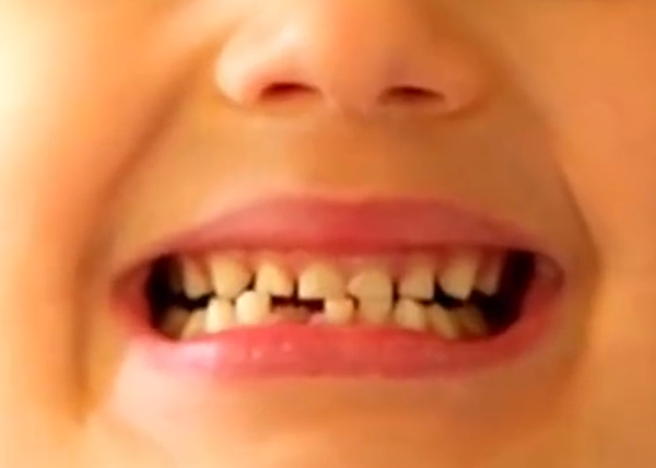 ▲4歲男全麻拔乳牙。（示意圖／翻攝自微博）