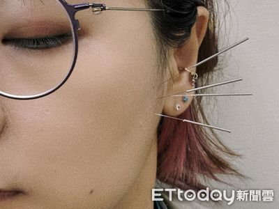 西醫、牙醫完成192小時訓練都可針灸　衛福部：不能報健保