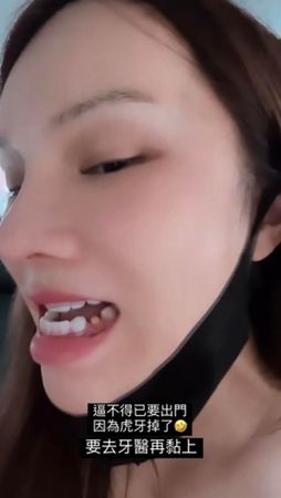 小A辣曾分享自己斷牙的事件，想不到竟是前一夜和大咖球星約會。（翻攝自小A辣IG）