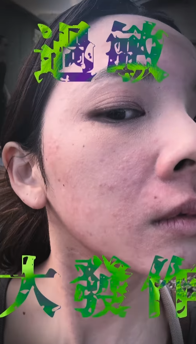 ▲▼滴妹全身大過敏。（圖／翻攝自Instagram／crown_du）