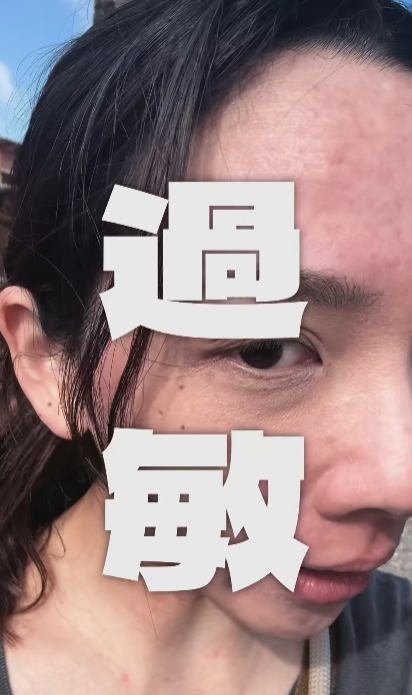 ▲▼滴妹全身大過敏。（圖／翻攝自Instagram／crown_du）