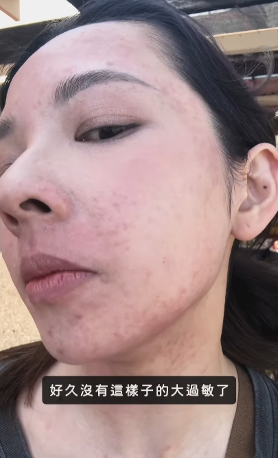 ▲▼滴妹全身大過敏。（圖／翻攝自Instagram／crown_du）