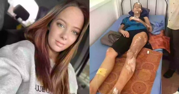 18歲少女遇「加油站氣爆」全身40％燒傷　6年後重生近照好驚人