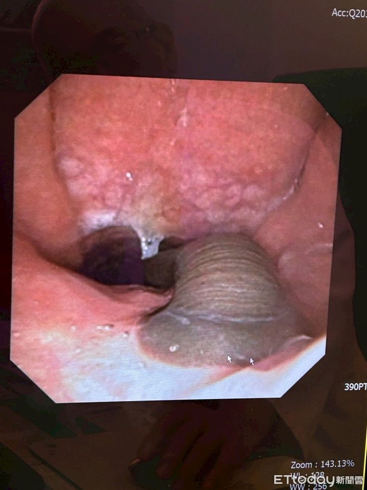 喉嚨癢！驚見活跳跳4cm水蛭鼻腔內蠕動　醫出奇招：噴農藥擊落牠