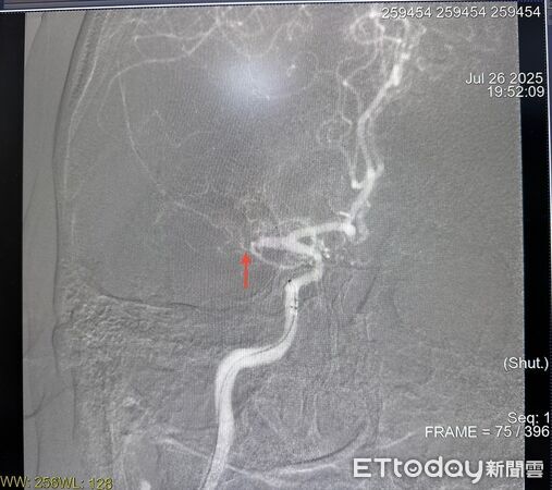 ▲中風處。（圖／衛福部南投醫院提供）